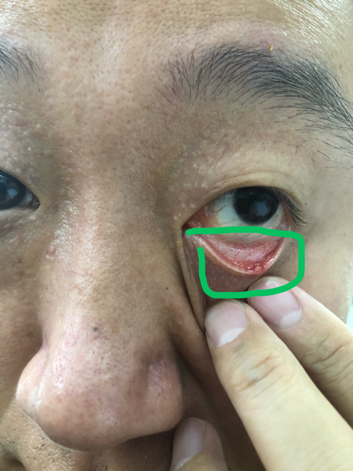眼睛周围长汗管瘤是什么原因造成的？ - 知乎