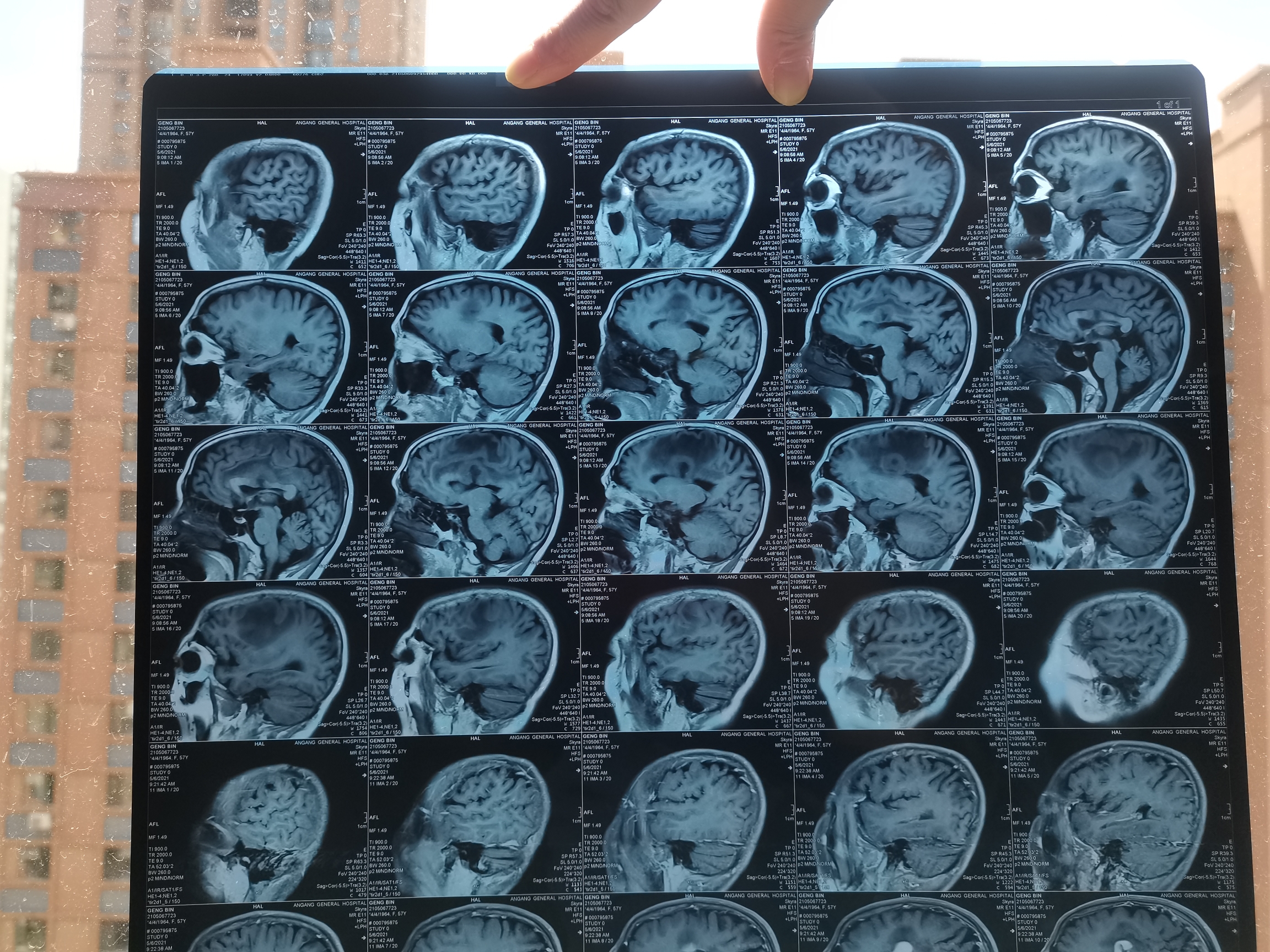 颅内原发中枢淋巴瘤有自体移植的吗?效果怎么样(弥漫大b)