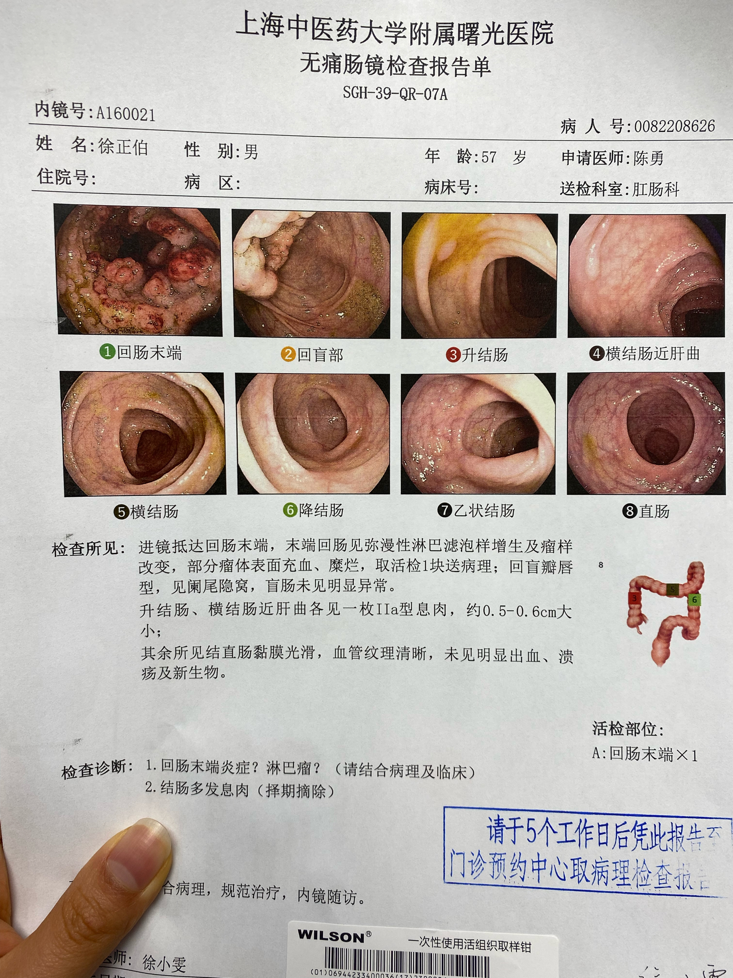 回肠末端淋巴滤泡增生图片