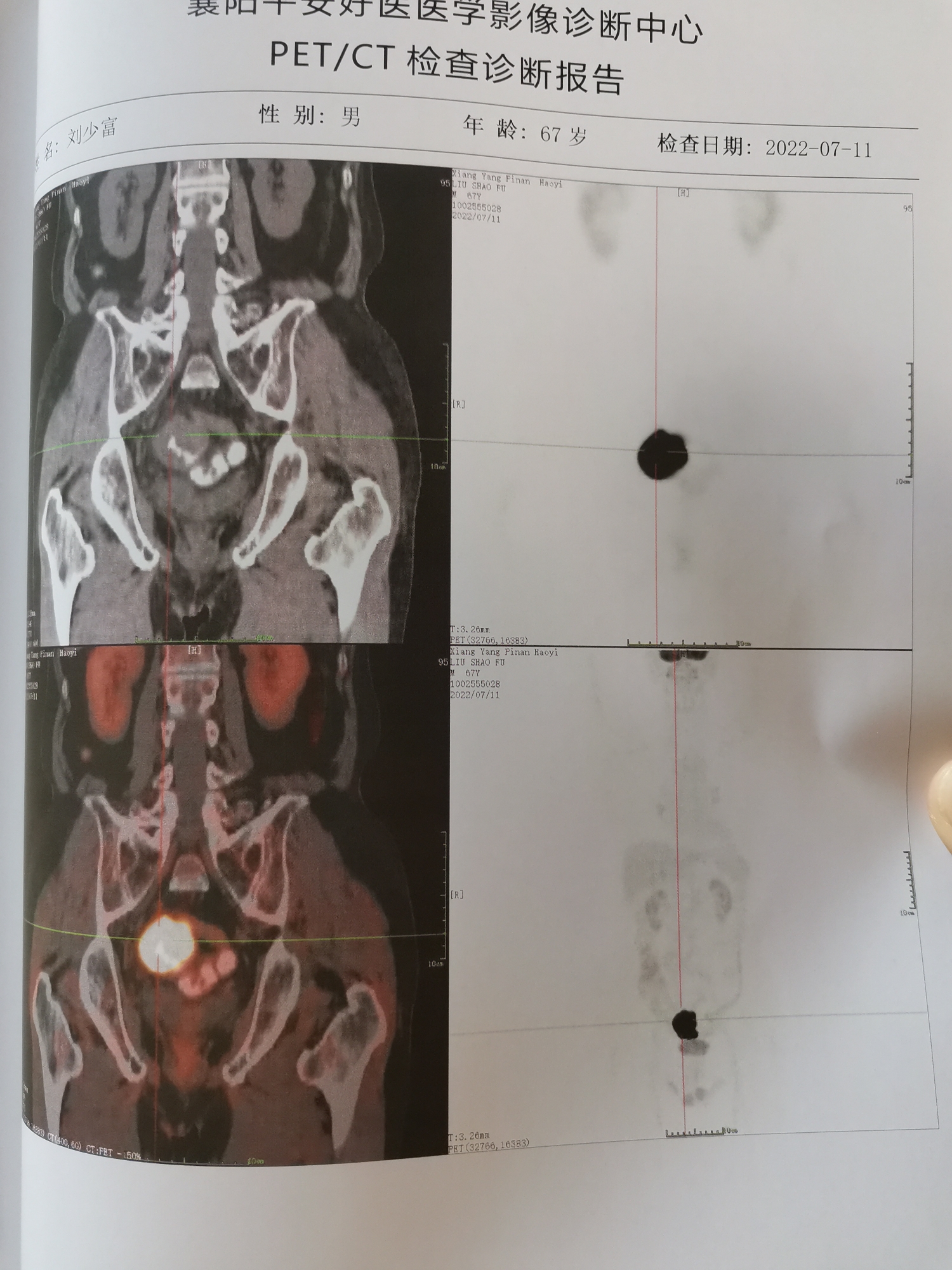 对比了一下两次派特,还是有一定效果吧?-淋巴瘤之家