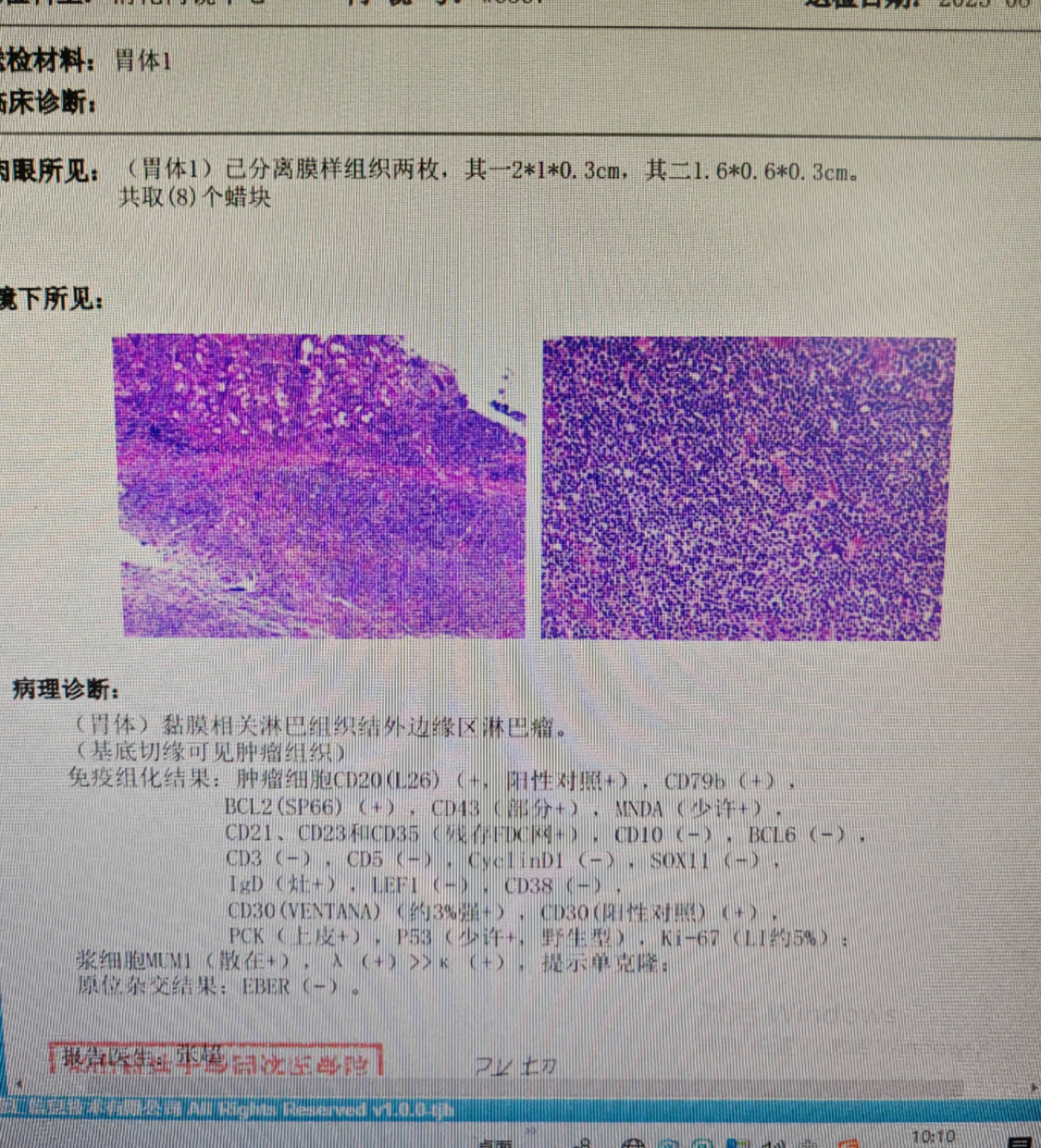 求助新人求帮忙看看免疫组化结果