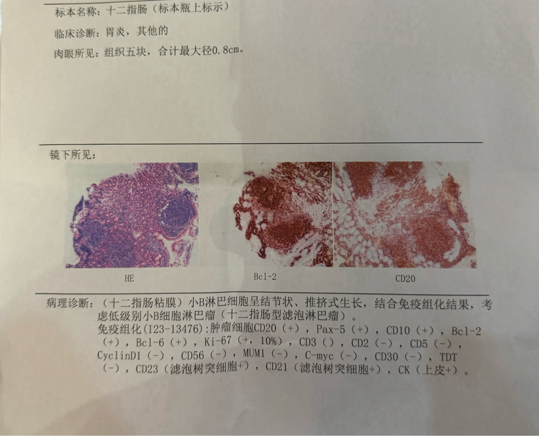 回肠末端淋巴滤泡增生图片